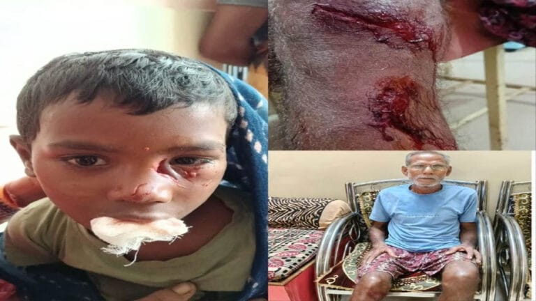 बागबाहरा में लोमड़ी का आतंक: बच्ची समेत तीन लोगों पर हमला, गांव में दहशत
